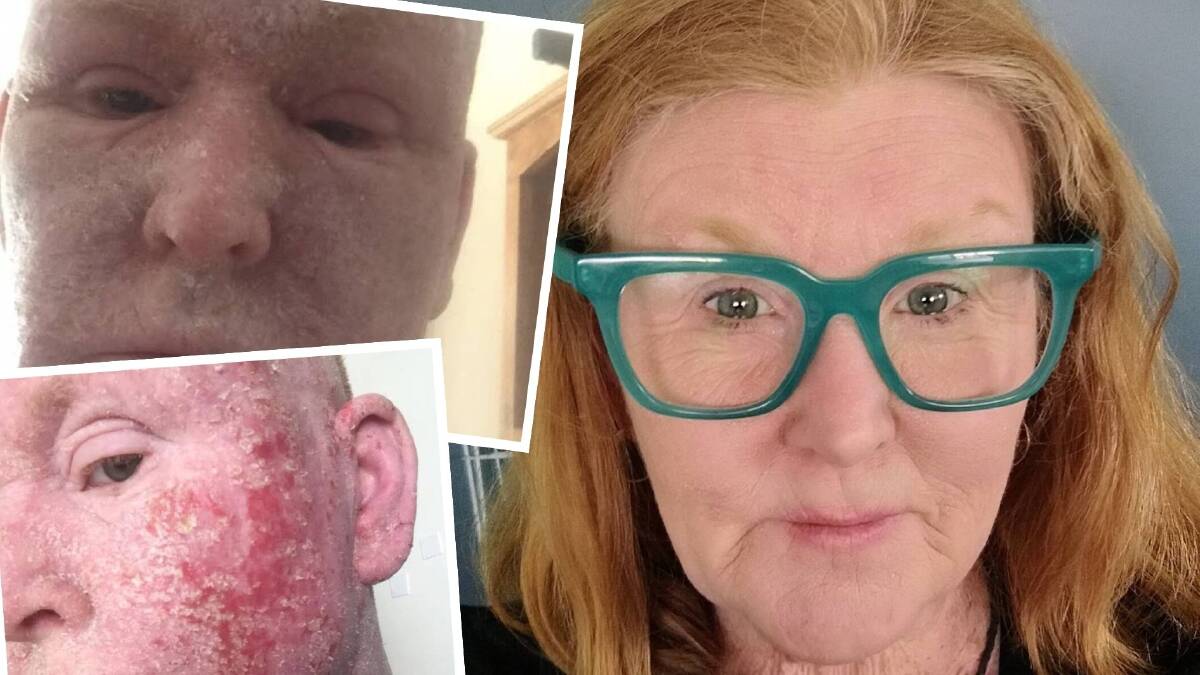 Jo Scaife's eczema before and after treatment. Pictures supplied Jo Scaife's eczema before and after treatment. Pictures supplied