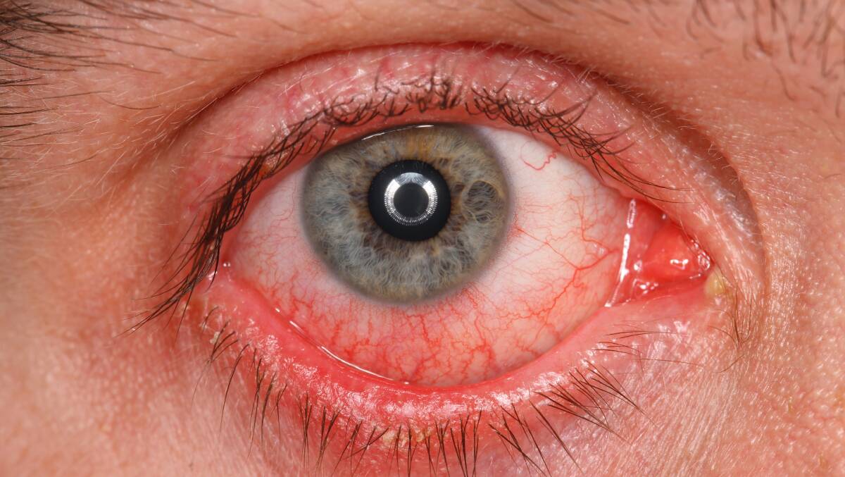 A new COVID-19 variant nicknamed Arcturus is linked to a new symptom. File picture.