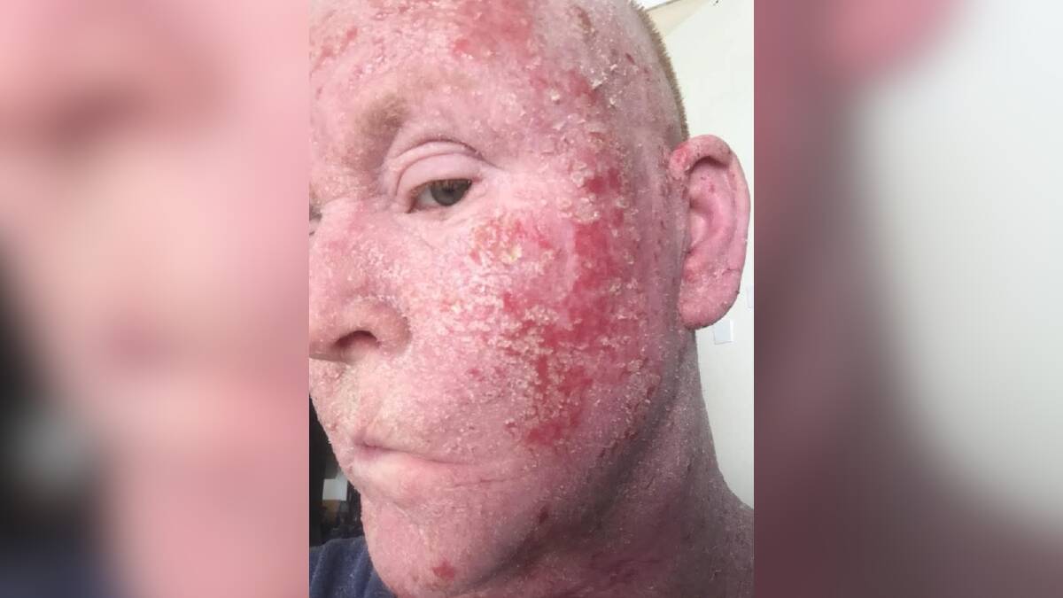 Jo Scaife during an exacerbation of her eczema. Jo Scaife during an exacerbation of her eczema.