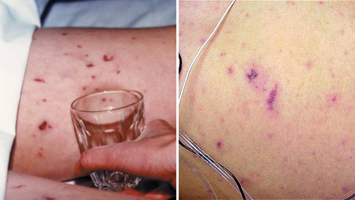 A well-known symptom of meningococcal disease is a rash, which does not disappear when pressed with a glass. Pictures from Meningitis Now and the Royal Children's Hospital Melbourne.