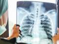Tuberculosis is still killing thousands of people a day. Where's the urgency? Picture Shutterstock