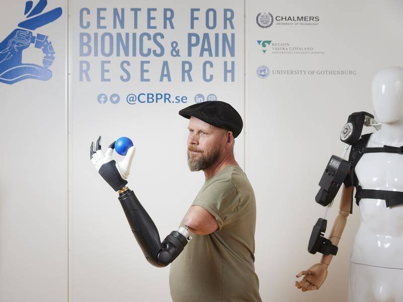A patient wears a prosthetic arm with an implant that allows the user to control every finger. (PR HANDOUT IMAGE/AAP PHOTOS)