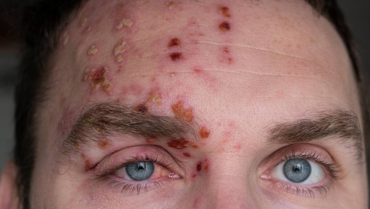 Shingles on the face can cause vision damage. Picture Shutterstock
